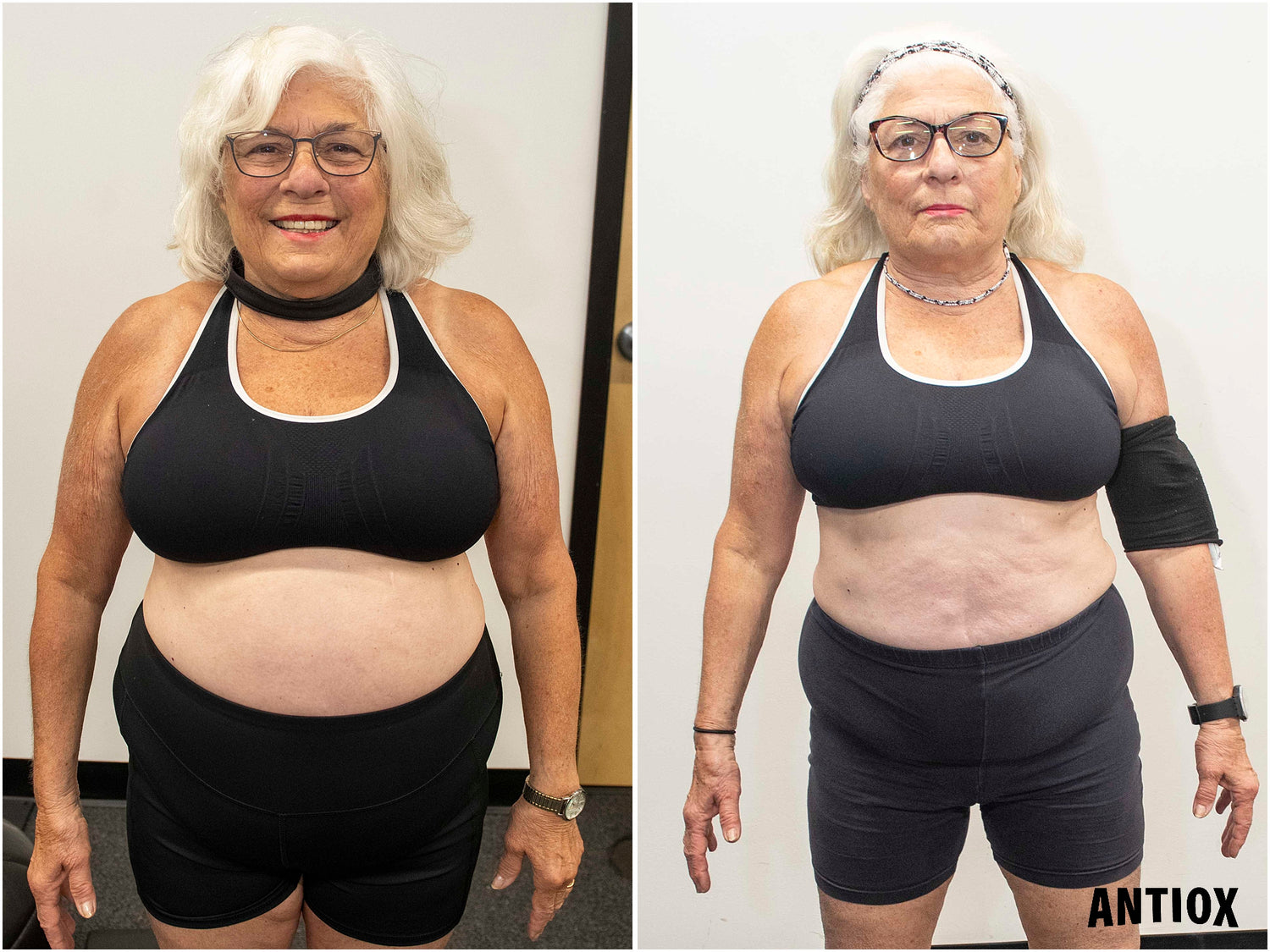 ANTIOX client before-and-after comparison with the client’s face visible